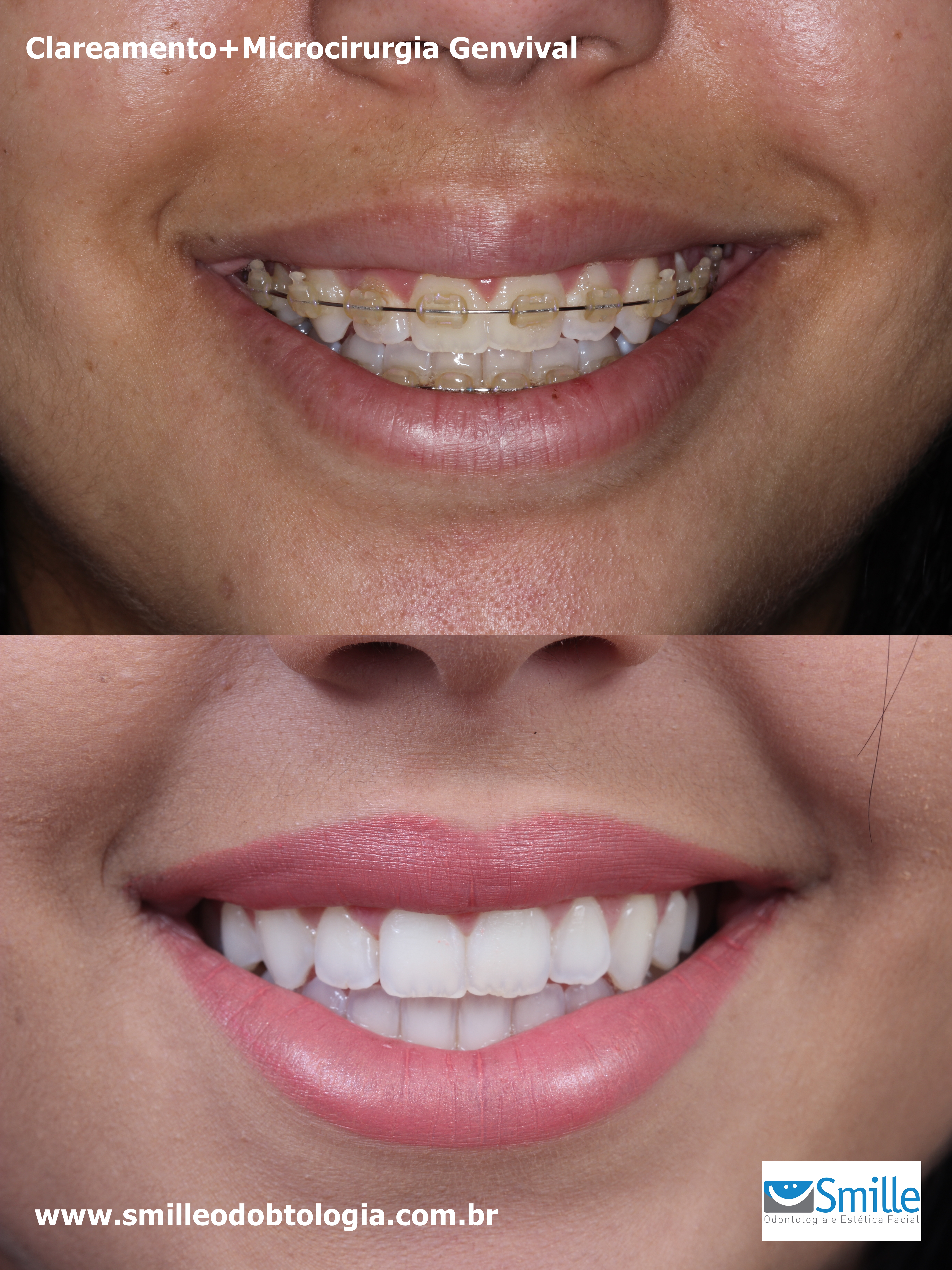 Mulher com sorriso rejuvenescido